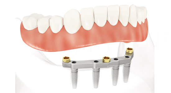 mini-implant-dentaire